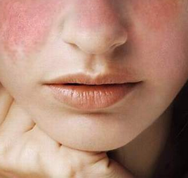 LUPUS BAN ĐỎ, CĂN BỆNH NGUY HIỂM ÍT NGƯỜI BIẾT